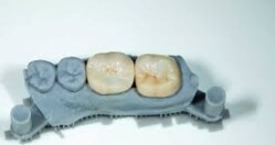 New technology enables fast and durable 3D-printed dental crowns